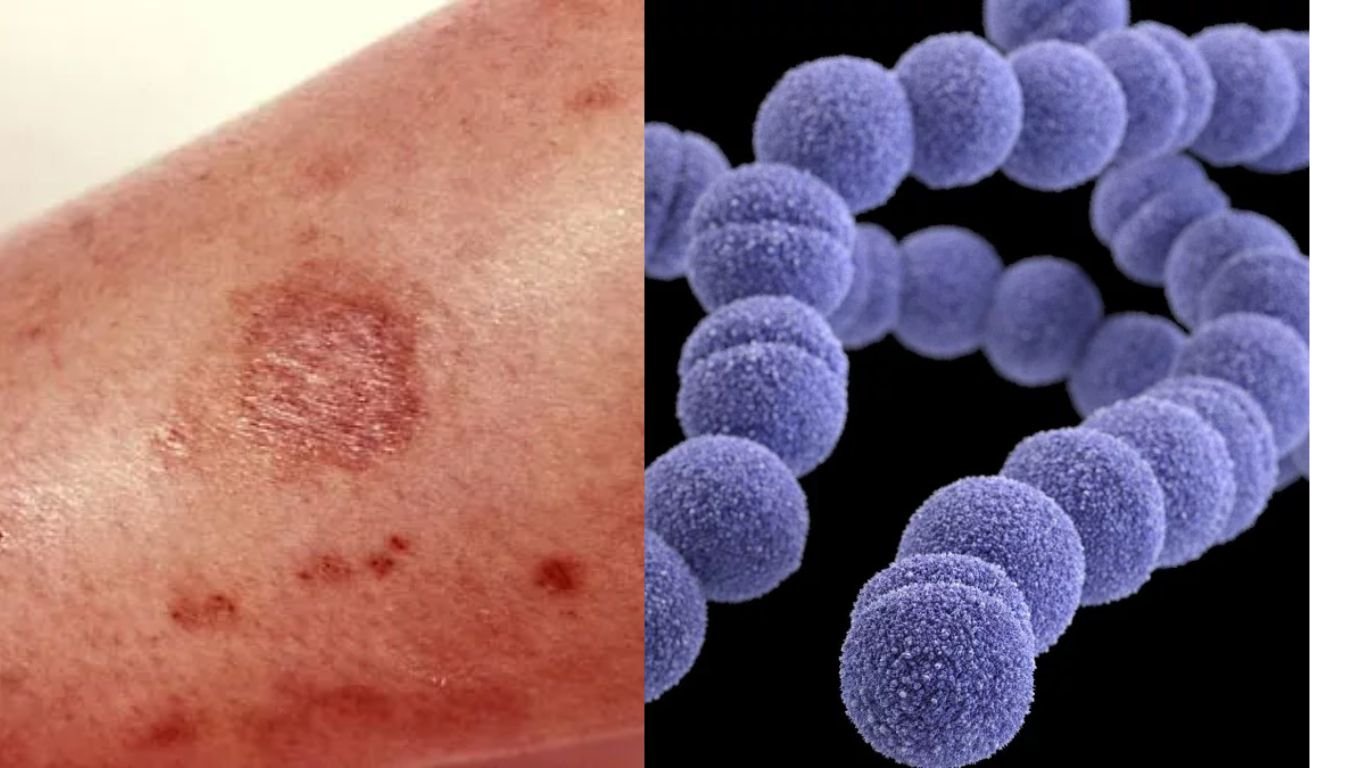 Infección bacteriana y mortal en Japón genera incertidumbre global